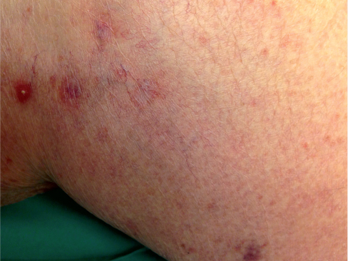 dermatoses infectieuses